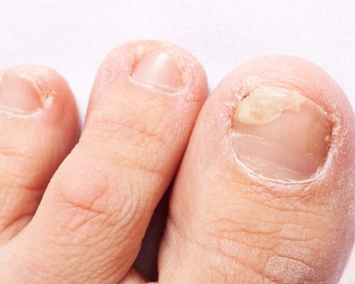 fungal nail infection (Onychomycosis). dry coarse skin of the legs (eczema)