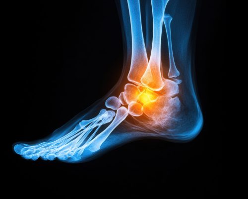 An X-ray of a foot with the ankle highlighted in yellow