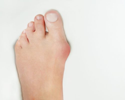 Hallux valgus, bunion in foot on white background